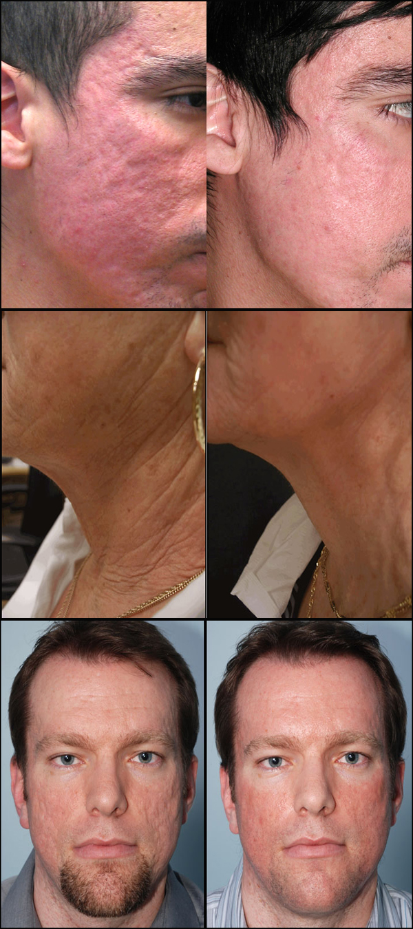 Manufacturer supply 2Mhz portable fractional RF micro needle machine for Wrinkle removal Facial wrinkle removal