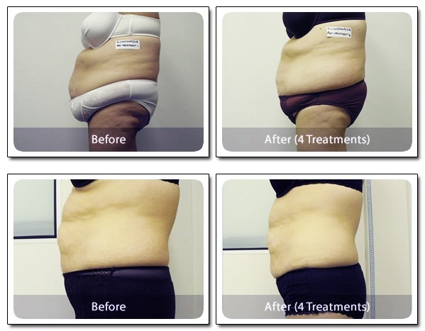 12 paddles i lipo laser/dual wavelength lipolaser slimming machine