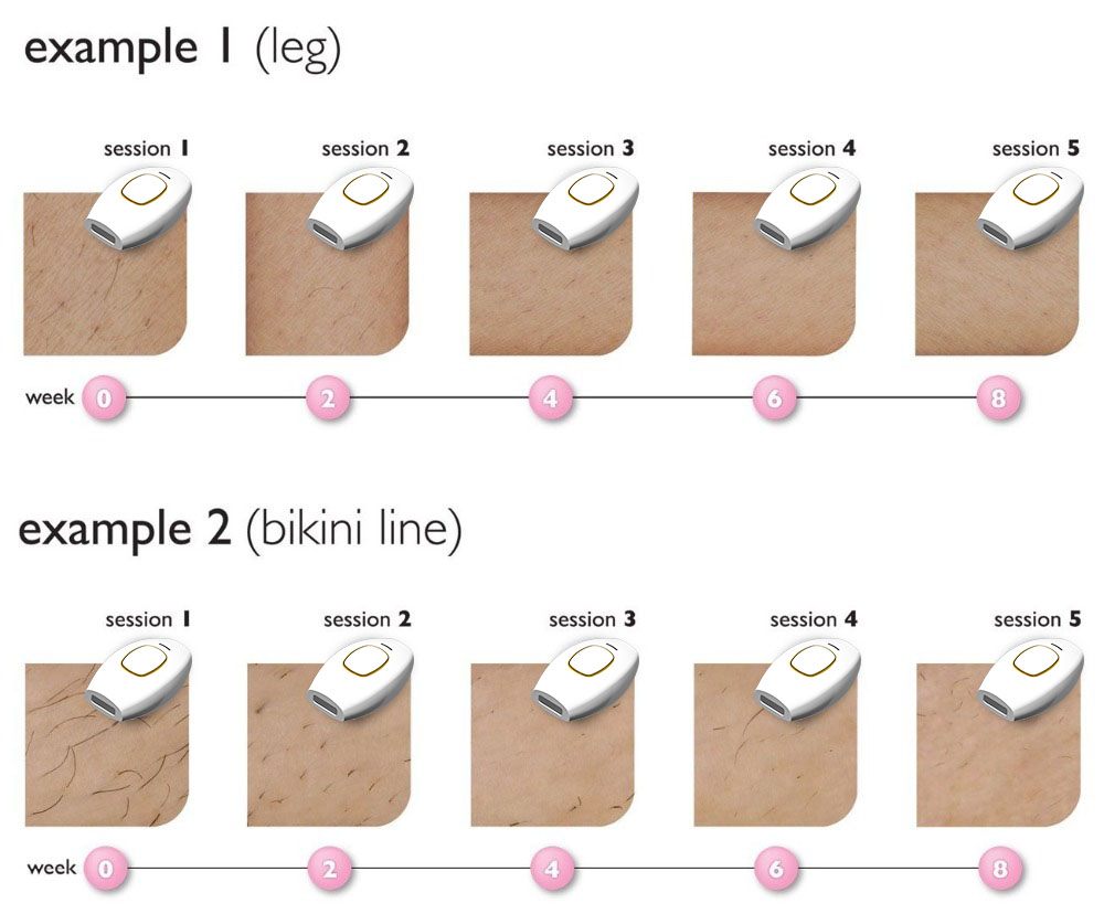 Dropshipping 2021 Ipl Laser Hair Removal