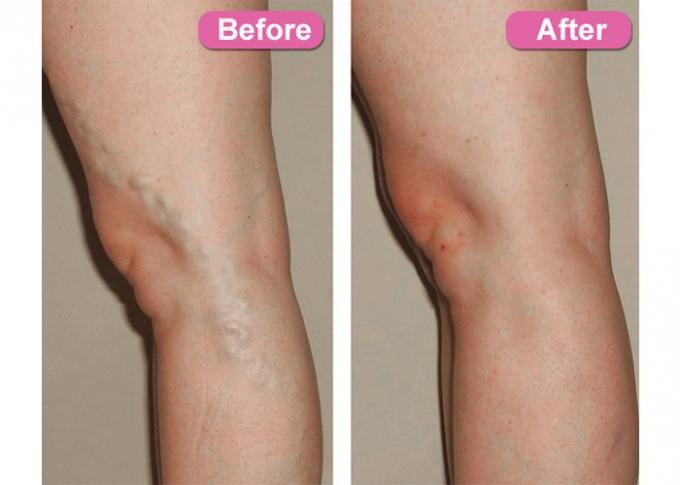 Painless 980 Nm Diode Laser For Vascular Removal 10us To 3s