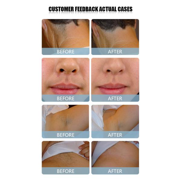 Full Body Painless 808nm Diode Laser Hair Removal Machine For Blonde Hair