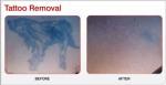 Protable Q - Switched ND YAg Laser Tattoo Removal Equipment With 1064nm / 532nm