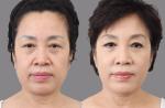 Beauty & Personal Care HIFU FACE hifu focused ultrasound beauty treatment for