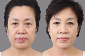 China Beauty &amp; Personal Care HIFU FACE hifu focused ultrasound beauty treatment for instant face lifting wholesale