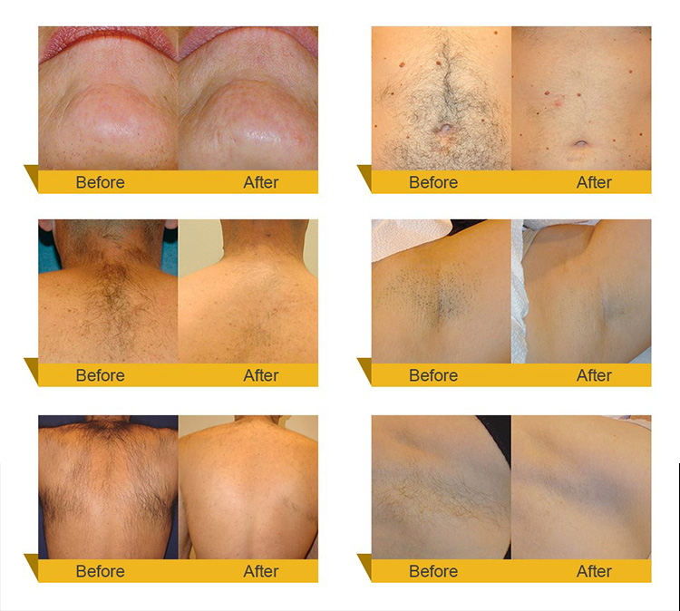 3500 W Diode Laser Hair Removal Machine With 8.4 '' Color Touch LCD Screen