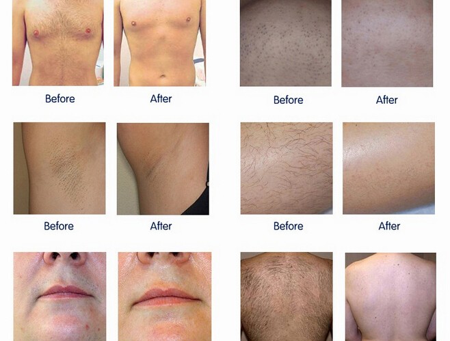 Firmly quality permanent hair removal ice diode laser machine made in China