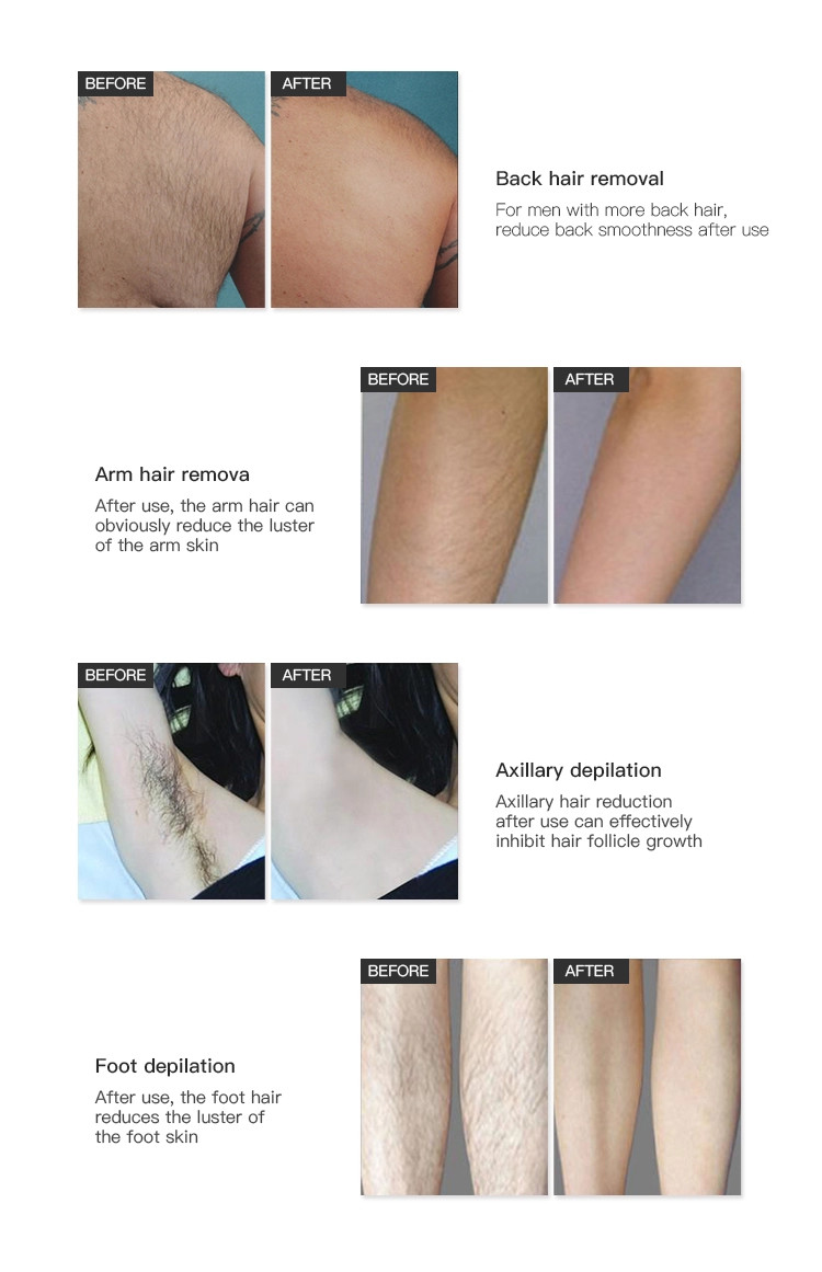 OEM CE Approved Diode Laser Hair Removal Machine 10.4 Inch Touch Screen