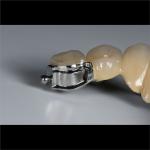 Aesthetic Partial Denture Precision Attachments Medical Grade OEM