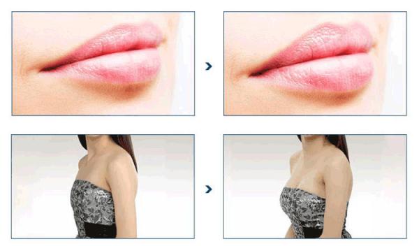HA face injection hyaluronic acid injections korea face line lip fillers buttock augmentation korea