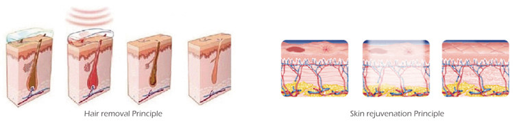 Multifunction system Shr Elight beauty equipment portable hair removal ipl rf