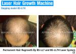 Diode Laser Treatment Hair Growth Laser Light Device