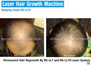 China Laser hair regrowth equipment Beauty Salon Laser Hair Regrowth Machine For Hair Loss Treatment factory direct wholesale wholesale