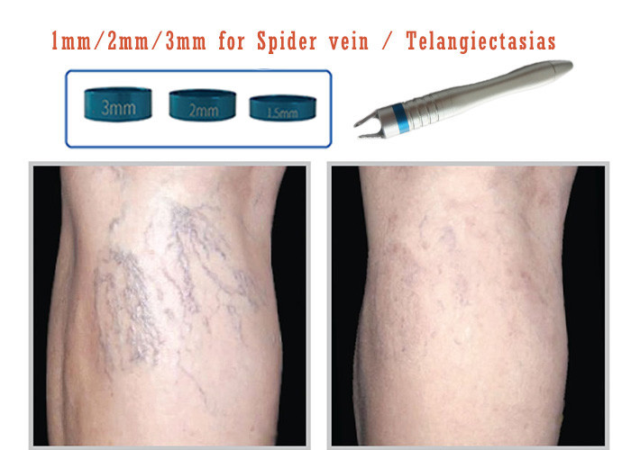 15 Watts Spider Vein Removal Machines 532nm Non Invasive