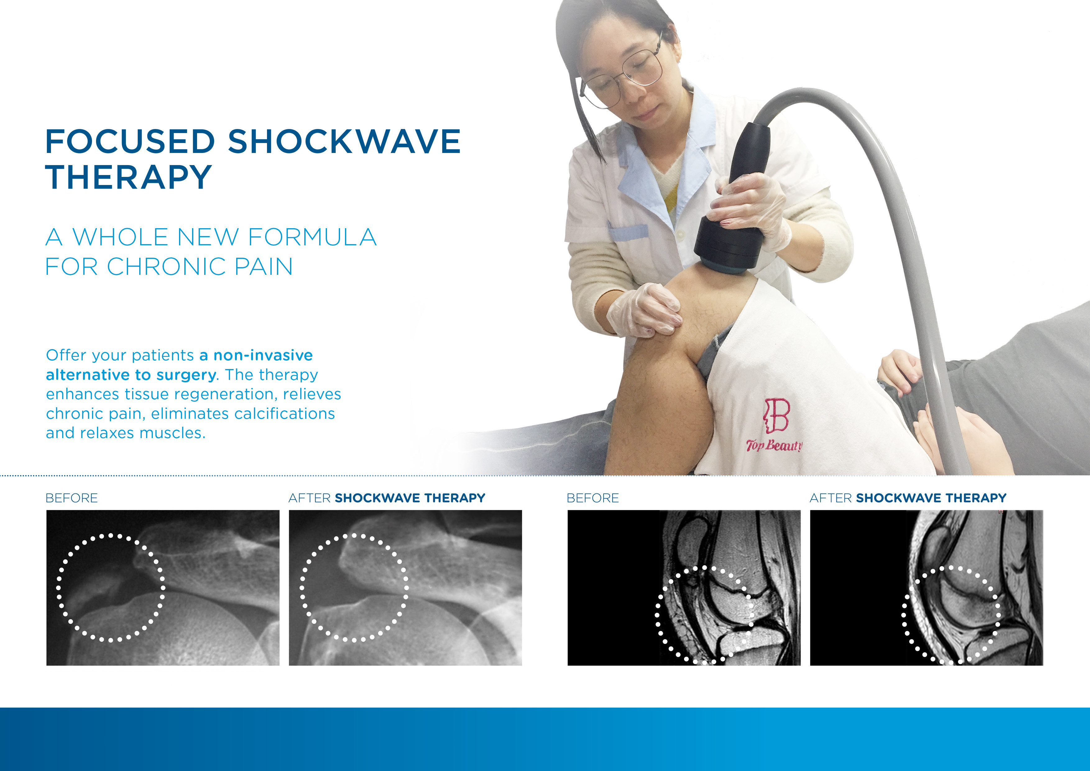 10bar Focused Extracorporeal Erectile Dysfunction Shock Wave Shockwave Therapy Machine