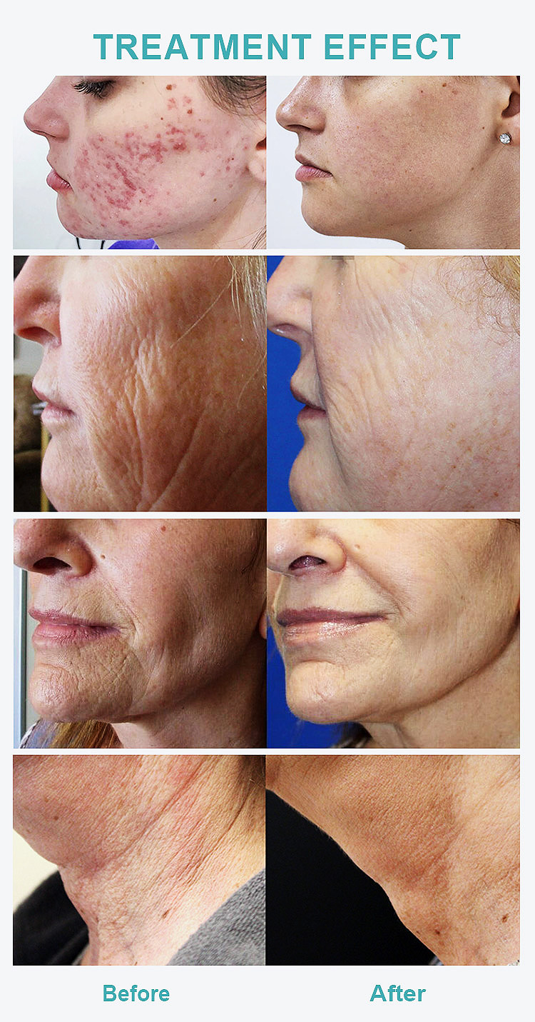 Vacuum Fractional Rf Microneedle Machine For Acne Scars