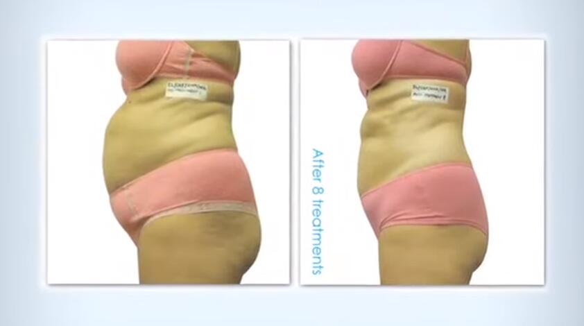 diode laser 808nm 810nm remove undesired hairs permanently.jpg