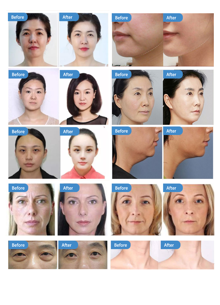 Thread Face Lift Face Lifting Device Radio Frequency Skin Tightening Face Lift Rf Equipment