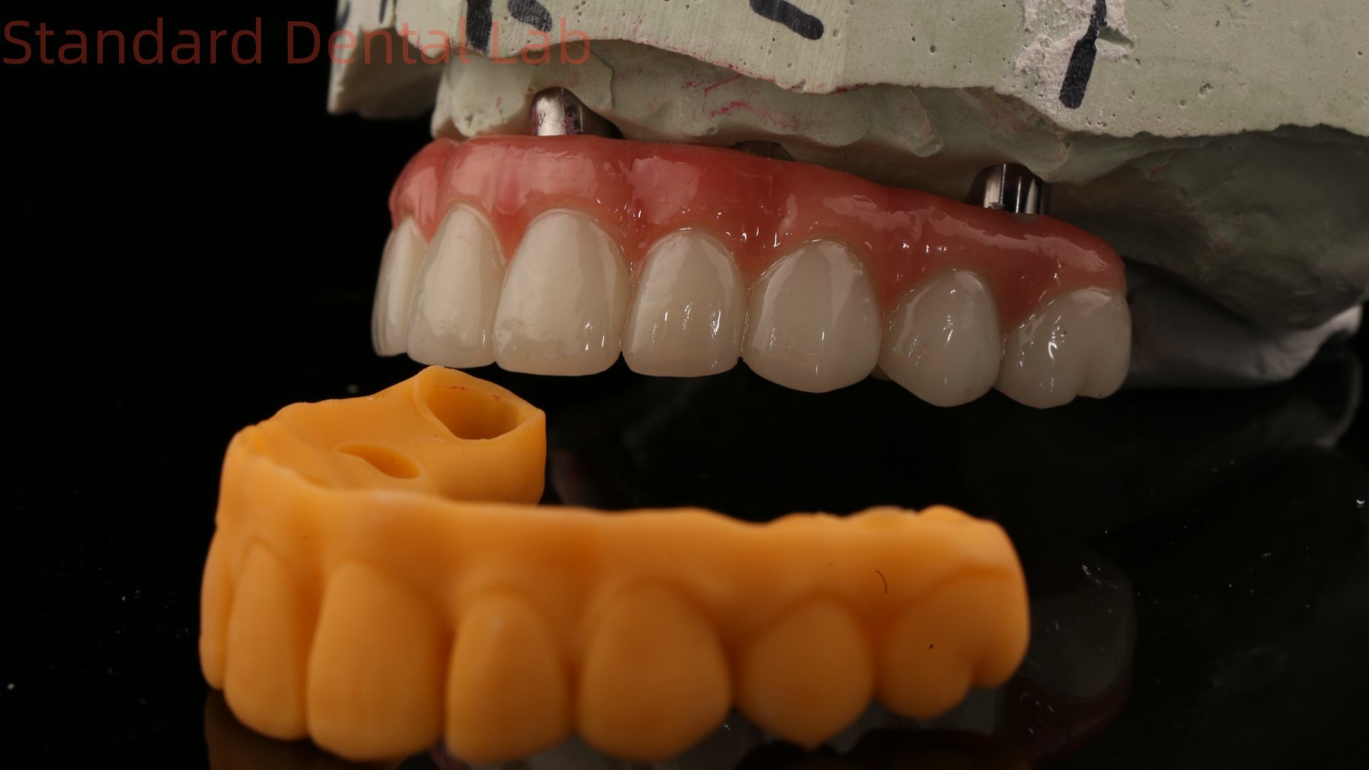 5 Year Guarantee Dental Implant Crown PMMA Bridge Over Multi Unit Abutments Customized Vita Shade