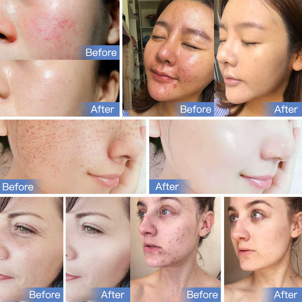 Commercial Led Light Facial Therapy PDT Machines For Clinic Medical