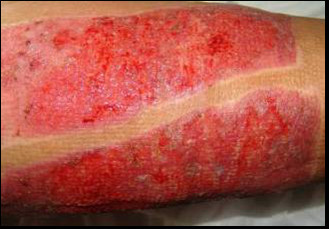 good quality diabetic ulcers red LED light therapy wound healing equipment