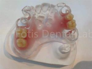 China Hypoallergenic Stain Resistant TCS Valplast Dental Prosthetics For Long Lasting Comfort wholesale