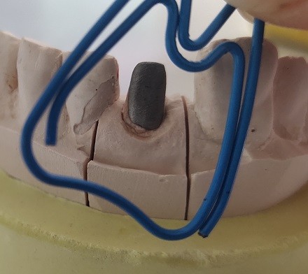 ISO13485 Pivot Core Dental Post And Core For Fracture Tooth