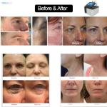 High Efficiency Plasma Facial Machin Anti Sterilization And Acne Removal