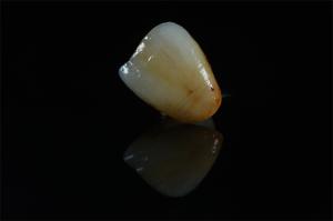 China Premium Zirconia Crowns with Natural-Looking Stain - China Dental Manufacturer wholesale