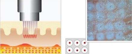 Fractional radiofrequency micro needling skin maintenance microneedle nurse system