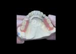 Durable Porcelain Fused To Metal Dental Crown PFM Crown For Restoration
