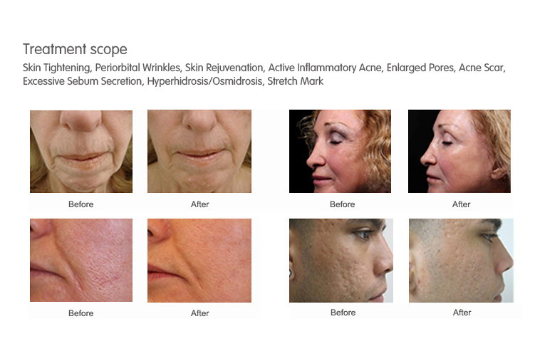 Top quality best rf skin tightening face lifting machine fractional microneedle rf