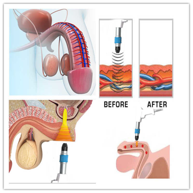 Multiple Forms Shockwave ED Machine For Sexual Impotency Long Life Time