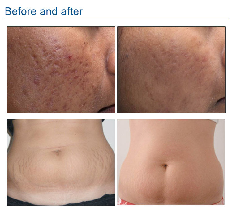 Fractional Micro Needle Rf Skin Needling Machine For Face And Body