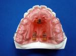 High Hardness FDA Functional Appliance Orthodontic Rubber Retainer