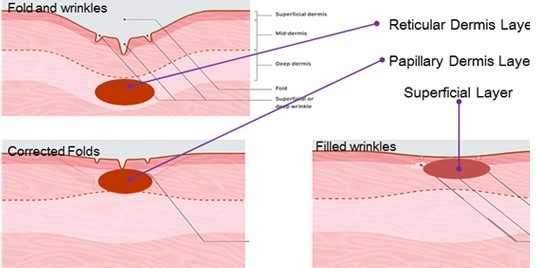Fractional radiofrequency micro needling skin maintenance microneedle nurse system