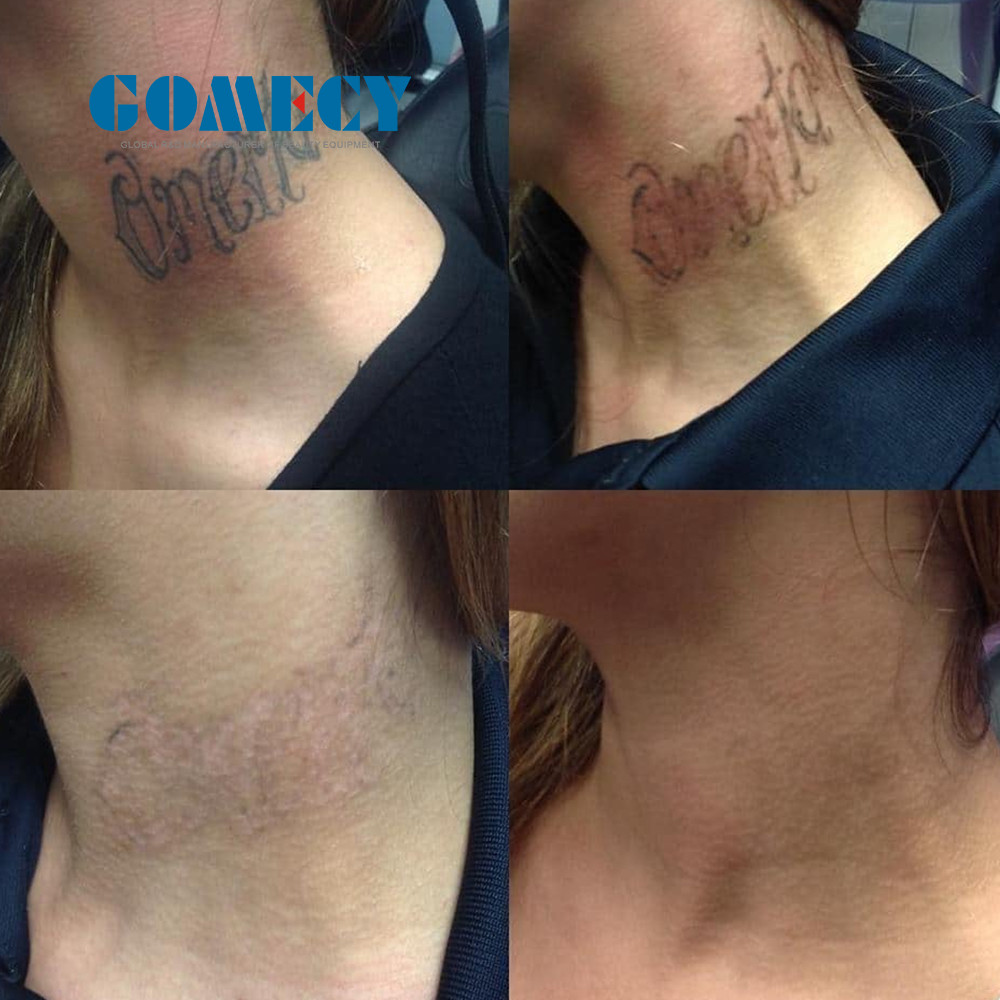 Picosecond Laser Tattoo Removal Machine Nd Yag Tattoo Remove Machine Picolaser Laser Pico Q-switch Carbon Laser Peel Machine