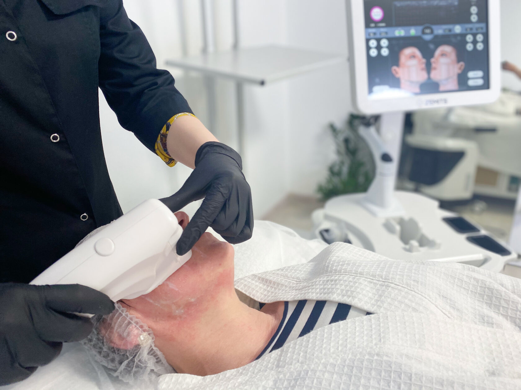 Ultra III 7D HIFU Machine For Ultrasound Lifting Tightening And Contouring