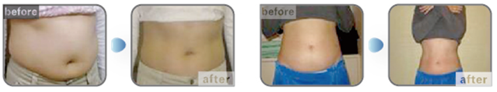 Best body slimming machine! Hot sale cryo fat reduction antifreeze cool sculpting fat freezing cryolipolyse machine