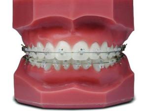 China Comfortable Fixed Orthodontic Appliances Beautiful Natural Ceramic Brackets wholesale