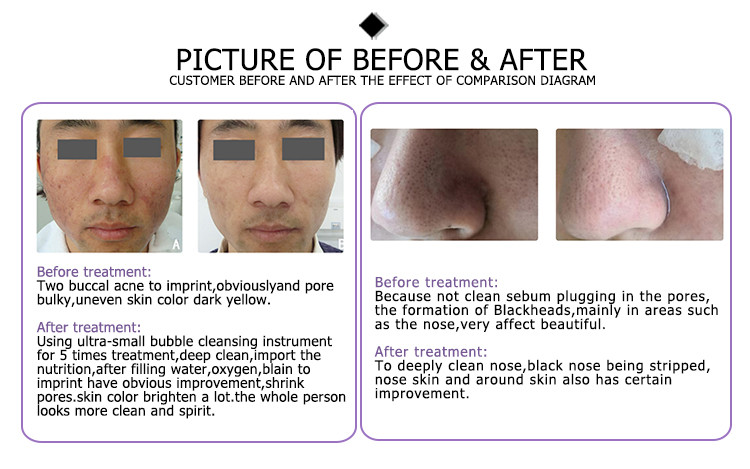dermabration apparatus cleanser dalton handset machine hydra water peel plus aqua facial