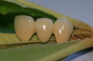 China ISO13485 Good Biocompatibility PFM Non Precious Dental Crown wholesale