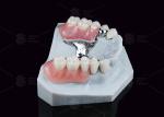 Dental Prostheses Key Way Attachment Precision Attachment Adjustable Retentive