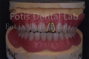 China Professional Technicians Acrylic Complete Denture Fake Teeth Prosthetics Precision Fit wholesale