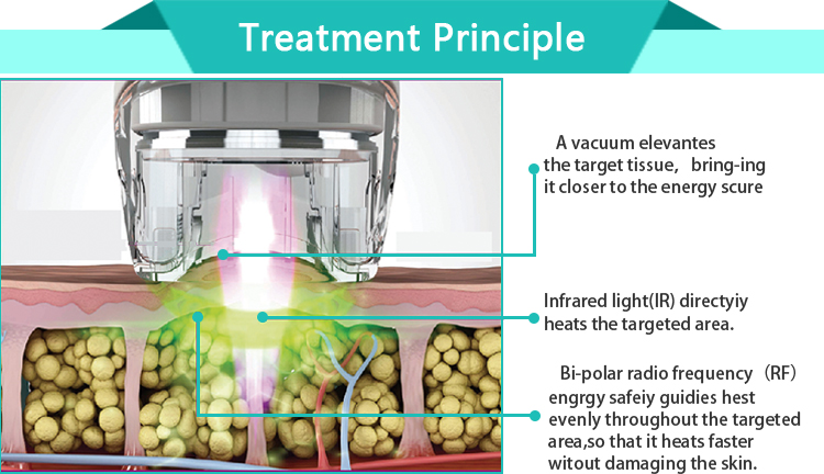 FDA approved ultrasound cavitation Radio frequency lpg endermologie machine price