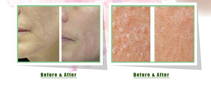 2mj~150mj Er Yag Laser Machine Stretch Mark Removal Laser Machine For Skin Rejuvenation