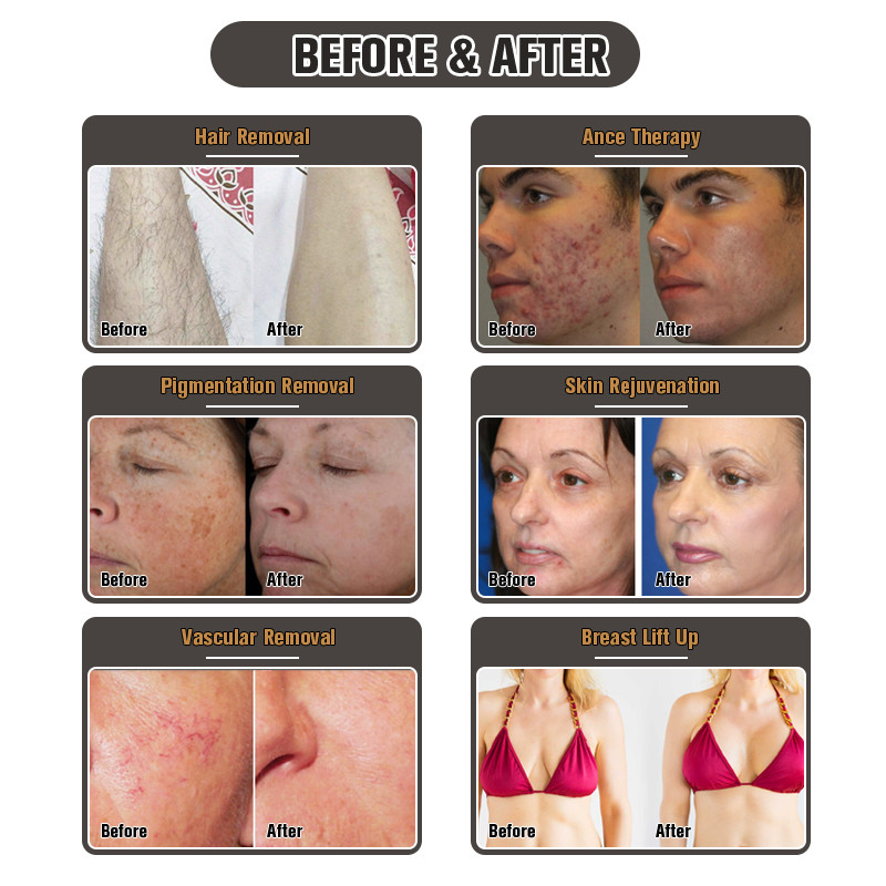 Painless Skin Rejuvenation Laser Machine IPL OPT SHR Hair Removal 7 Filters