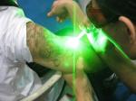 Dermatology Neodymium picolaser Nd Yag Laser 1064nm Portable