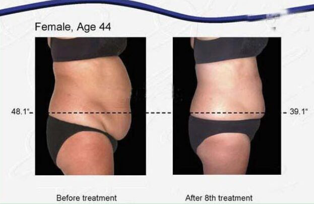 cavitation weight loss ipl hair removal ultrasonic cavitation slimming machine