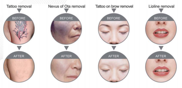 Salon Q Switch ND YAG Laser Machine 600mj / 300mj For Tattoo Removal
