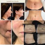 Non Surgical Liposuction Machine For Skin Tightening Fat Removal